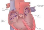 Riscul embolic in fibrilatia atriala